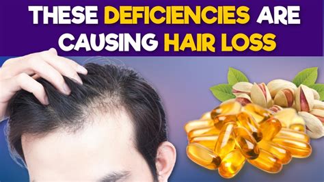 Nutritional Deficiencies That Cause Hair Loss Youtube