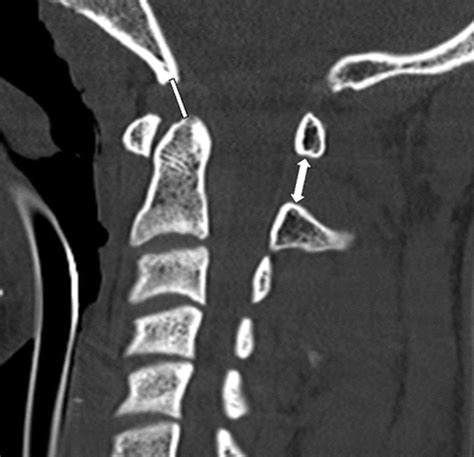 Imaging Of Atlanto Occipital And Atlantoaxial Traumatic Injuries What