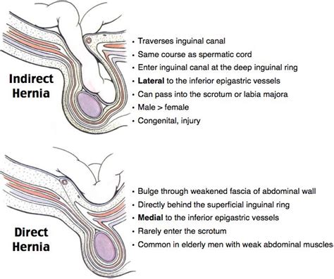 Inferior Epigastric Artery Direct And Indirect Ecosia Medical