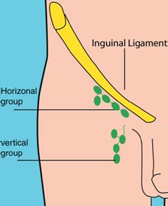 The majority of groin pain arises from the attachment of the inguinal ligament and lacunar ligament, the rectus muscle insertion, the pectineal fascia and ligament (also known as cooper's ligament) as well as problems arising from the. How to check your Lymph Nodes