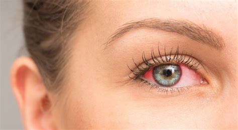 Red Eye Optometrist In Jackson Ca Sierra Eyecare Associates