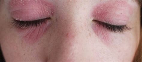 Dry Skin Around Eyes Or Eyelids Causes And Treatments Skincarederm
