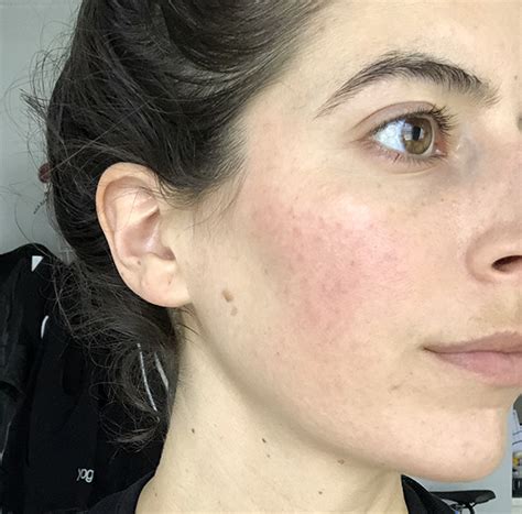 Essential Oils For Rosacea — My Story And Whats Helped Pumps And Iron