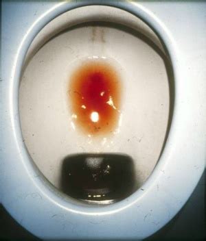 Gleichzeitig mit blut können leukozyten im urin auftreten. In diesem Bericht lesen Sie von einer fahrlässigen ...