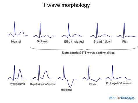 خصوصیات موج T در نوار قلب