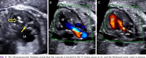 Figure 2 From First Reported Case Of Fetal Aortic Valvuloplasty In Asia Semantic Scholar