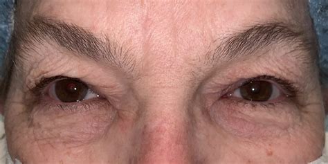 24 Upper Eyelid Surgery Before And After Photos Dallas Plano Texas