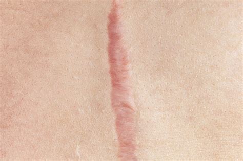 Hypertrophic And Keloid Scars How To Improve Them LIVING WITH SCARS
