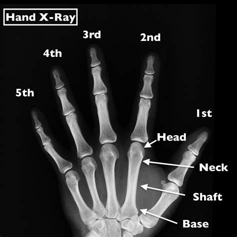 Boxer S Fracture 5th Metacarpal Fracture