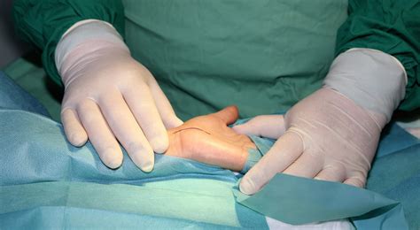 What You Need To Know About Carpal Tunnel Surgery Recovery Time