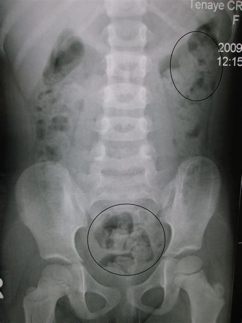 Post Operative Constipation Causes Laxatives Teachmesurgery