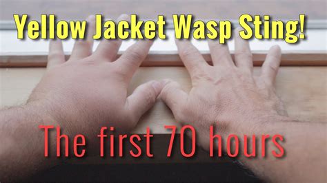 Yellow Jacket Wasp Sting The First 70 Hours Youtube