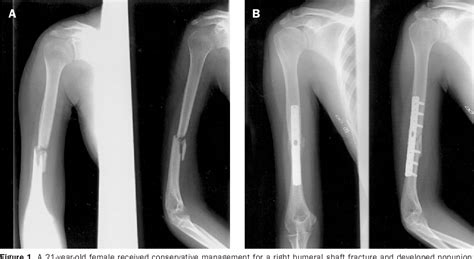 Pdf Treatment Of Nonunion Of Humeral Shaft Fracture With Dynamic