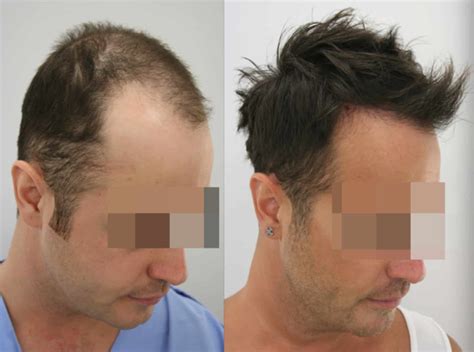 Hair Transplant Turkey From Free Consultation In Uk Gethair