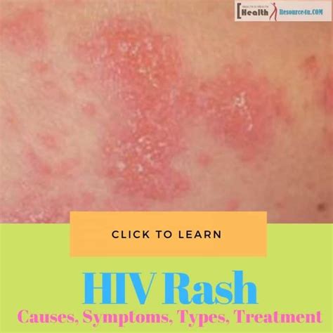 Hiv Rash Causes Picture Symptoms Types Home Treatment