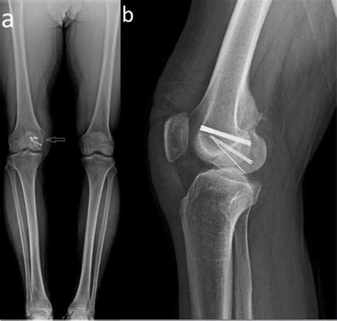 Medial Femoral Condyle Fracture Fixation
