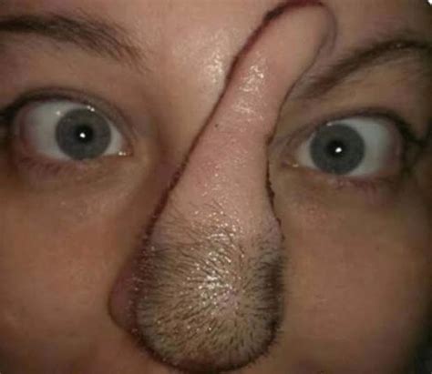Photos Woman Who Had Skin Cancer Given New Nose Using Flesh From Her Scalp