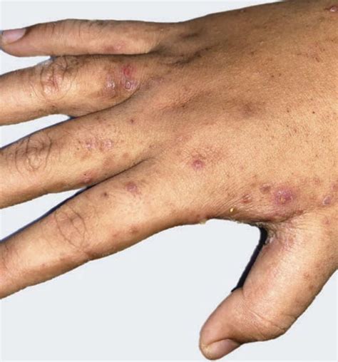Clinical Tips Scabies Charging Scheduling And Counseling The