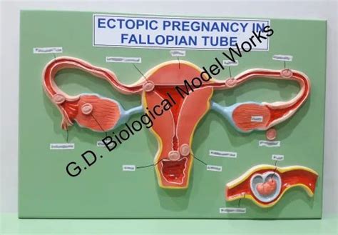 Ectopic Pregnancy In Fallopian Tube Pathology Model At Rs 2500piece