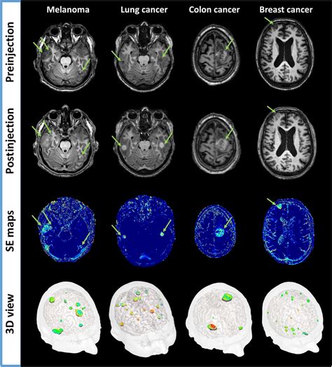 Targeting Brain Metastases With Ultrasmall Theranostic Nanoparticles A