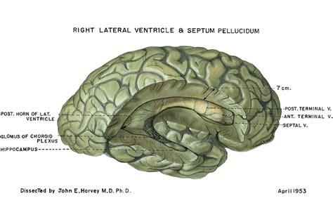 Ubrcolumbia Drawing Right Lateral Ventricle And Septum Pellucidum
