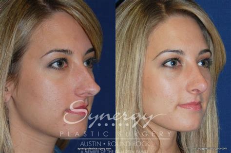 Rhinoplasty Before And After Photo Gallery Austin TX Synergy Plastic Surgery