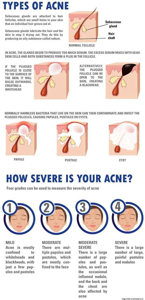 How Severe Is Your Acne Cysticacneremedies Types Of Acne Skin
