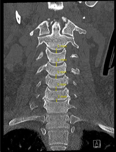 Subaxial Cervical Spine Ct Radiology Key
