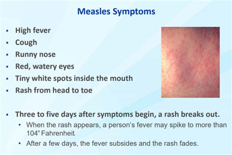 Public Health Officer No Confirmed Cases Of Measles In