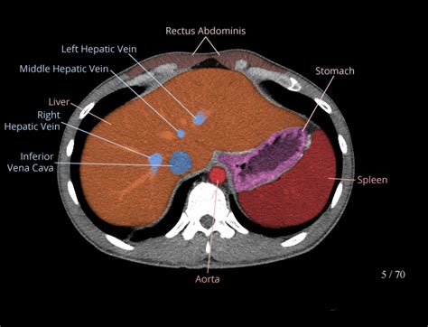 Labeled Ct Of Abdomen