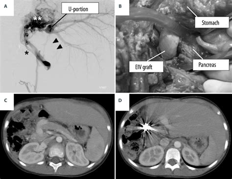 A Angiographic Findings Of Portal Vein Thrombosis Of Case 3 Note