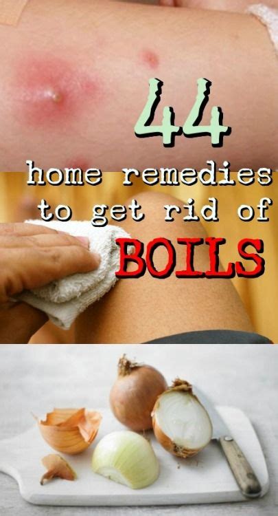 44 Simple And Effective Home Remedies To Get Rid Of Boil Get Rid Of
