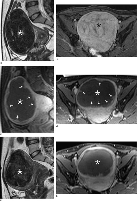Safety And Therapeutic Efficacy Of Complete Or Near Complete Ablation