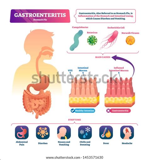 Gastroenteritis Vector Illustration Labeled Stomach Inflammation
