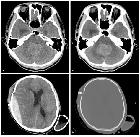 Figure 1 From Epidural Hematoma And Depressed Skull Fracture Resulted