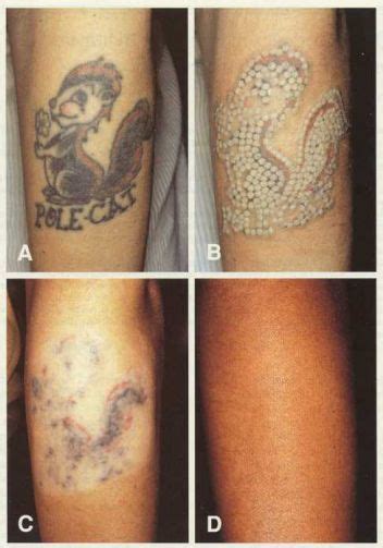100% accurate, in fact, we use this tool. 63 best Tattoo Removal Before and After images on ...