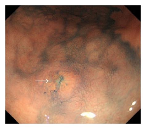 Esophagogastroduodenoscopy Reveals A Iic Lesion With A Size Of Mm
