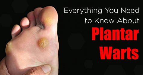 Everything You Need To Know About Plantar Warts