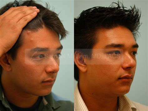 Dallas Mole Removal And Facial Excisions Before And After Photos