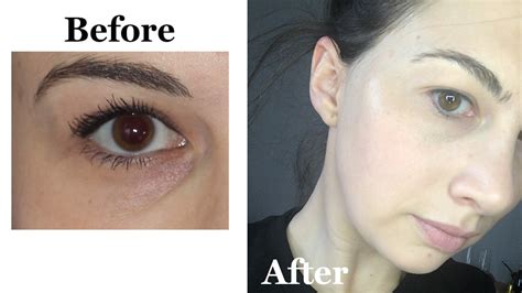 Fillers For Under Eye Circles Ideaologydesign
