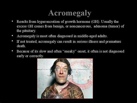 Pin By G Scotdeerie On Acromegaly And Gigantism Hormones Growth