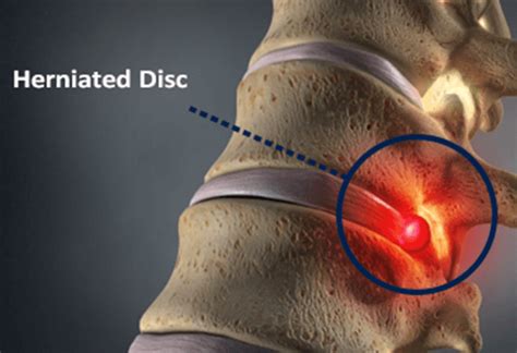 Herniated Disc Causes Symptoms And Treatment Bonati Spine Institute