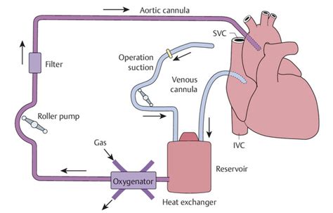 Cardiopulmonary Bypass