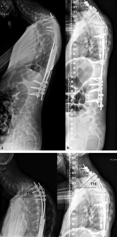 Upper Thoracic Osteotomy For Cervical Deformity Neupsy Key
