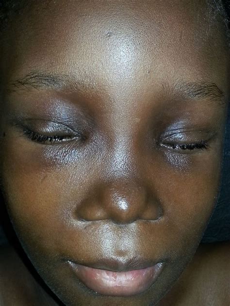 Juvenile Dermatomyositis In A Nigerian Girl Bmj Case Reports