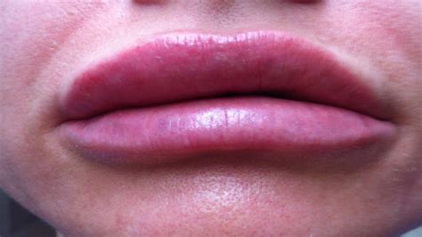 How To Get Rid Of A Swollen Lip Fast Home Remedies Swollen Upper