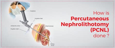 Percutaneous Nephrolithotomy Institute Of Urology