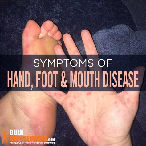 Hand Foot And Mouth Disease HFMD Symptoms Causes Treatment