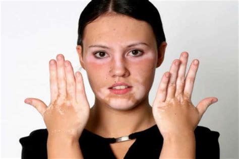 Causes Of Vitiligo And Treatment Tips Youm7 En24