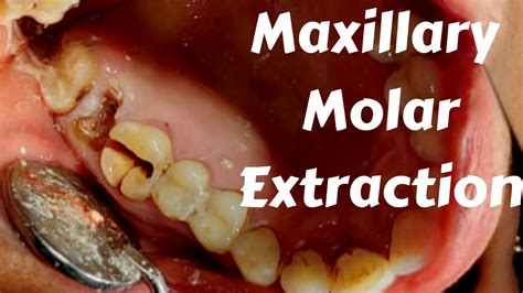 Maxillary Molar Extraction By Split And Section Technique And Complication